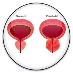 Prostatik Ağrı